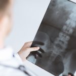 A Spinal Cord Injury can Lead to ED