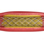 Are Stents Effective at Treating ED?