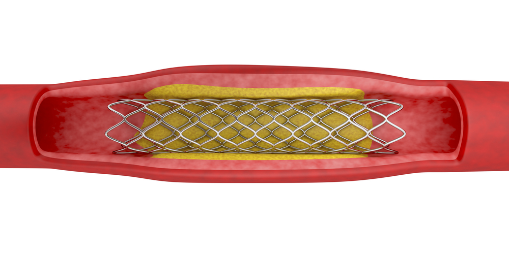 Are Stents Effective at Treating ED?