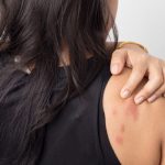 hives-and-skin.treatment-causes-and-symptoms