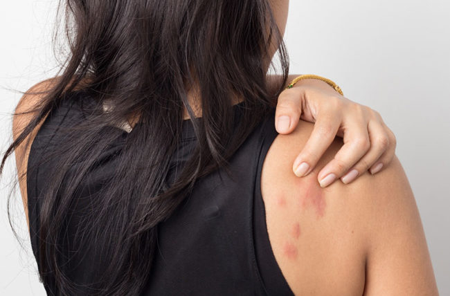 hives-and-skin.treatment-causes-and-symptoms