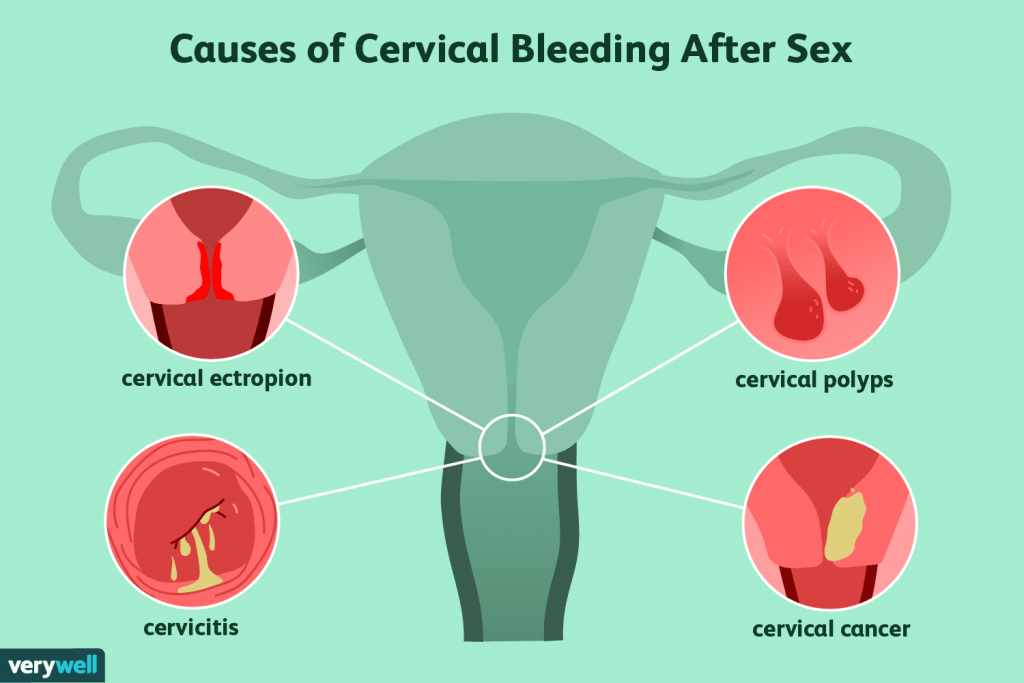Bleeding after Sex- Everything you should know | Erectile ...