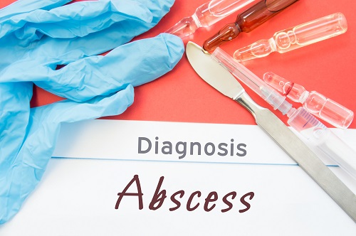 Diagnosis Abscess. Blue gloves, surgical scalpel, syringe and ampoule with medicine lie next to inscription Abscess. Causes, symptoms, diagnosis, treatment, diet of this surgical disease